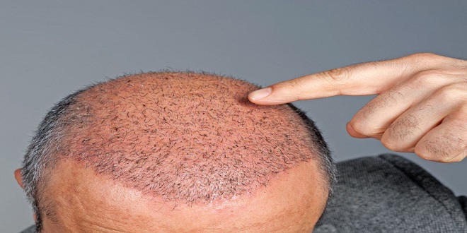 Beyond Baldness: Uncommon Reasons People Choose Hair Transplants